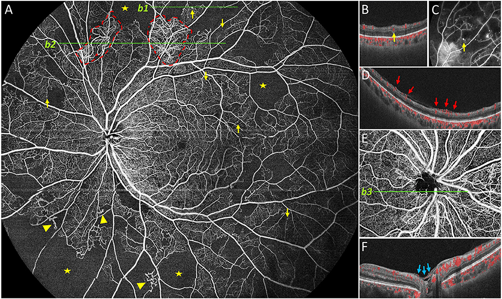 Ultra-wide-field fundus photographs and ultra-wide-field