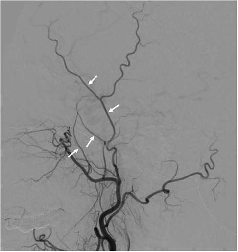 Frontiers | Outcomes after superficial temporal artery–middle 