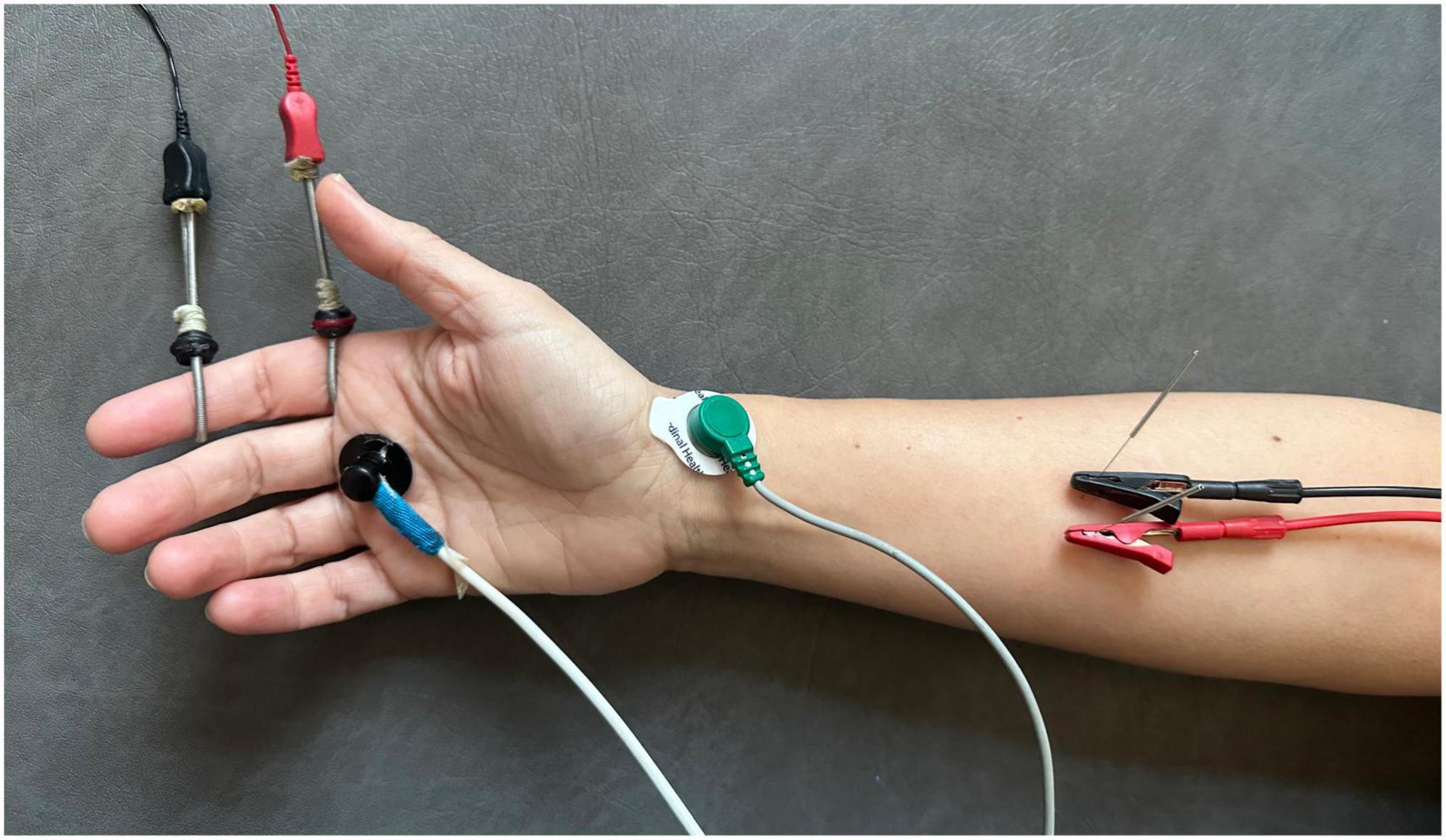 Percutaneous Electrical Nerve Stimulation and Electrical Muscle