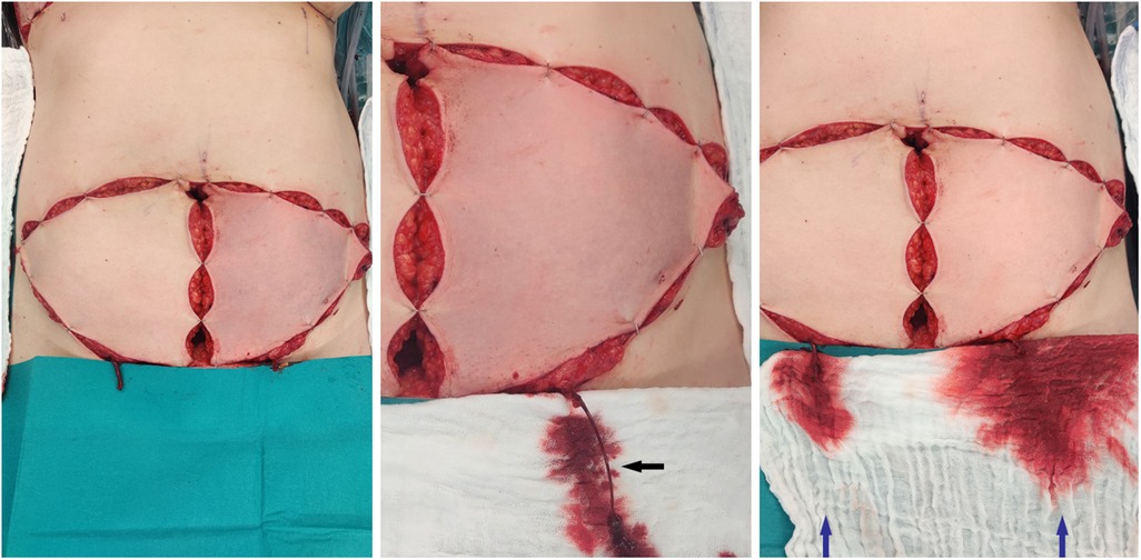 Frontiers  Use of the superficial inferior epigastric vein in breast  reconstruction with a deep inferior epigastric artery perforator flap