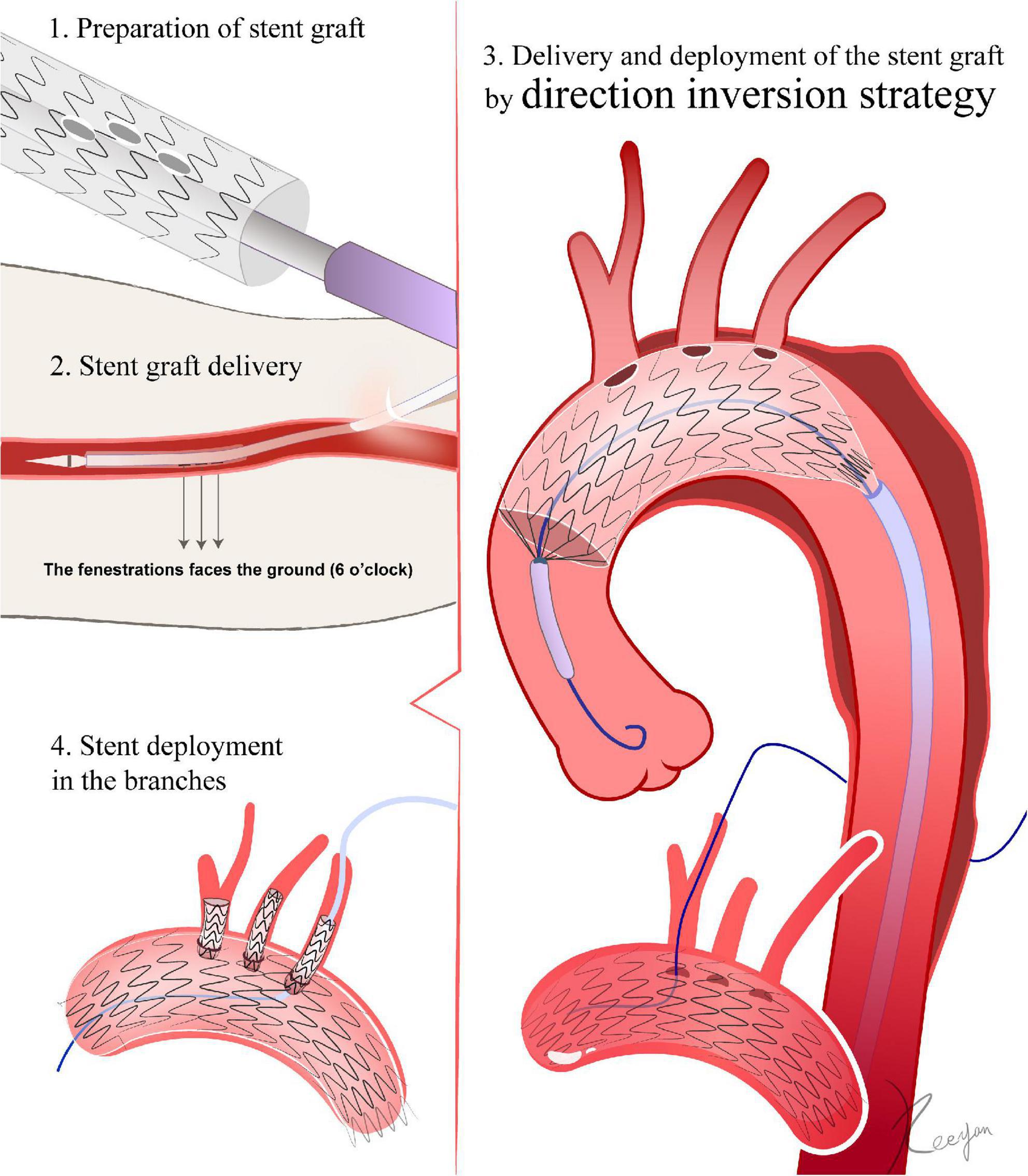 Frontiers Technical Details Of Thoracic Endovascular Aortic Repair