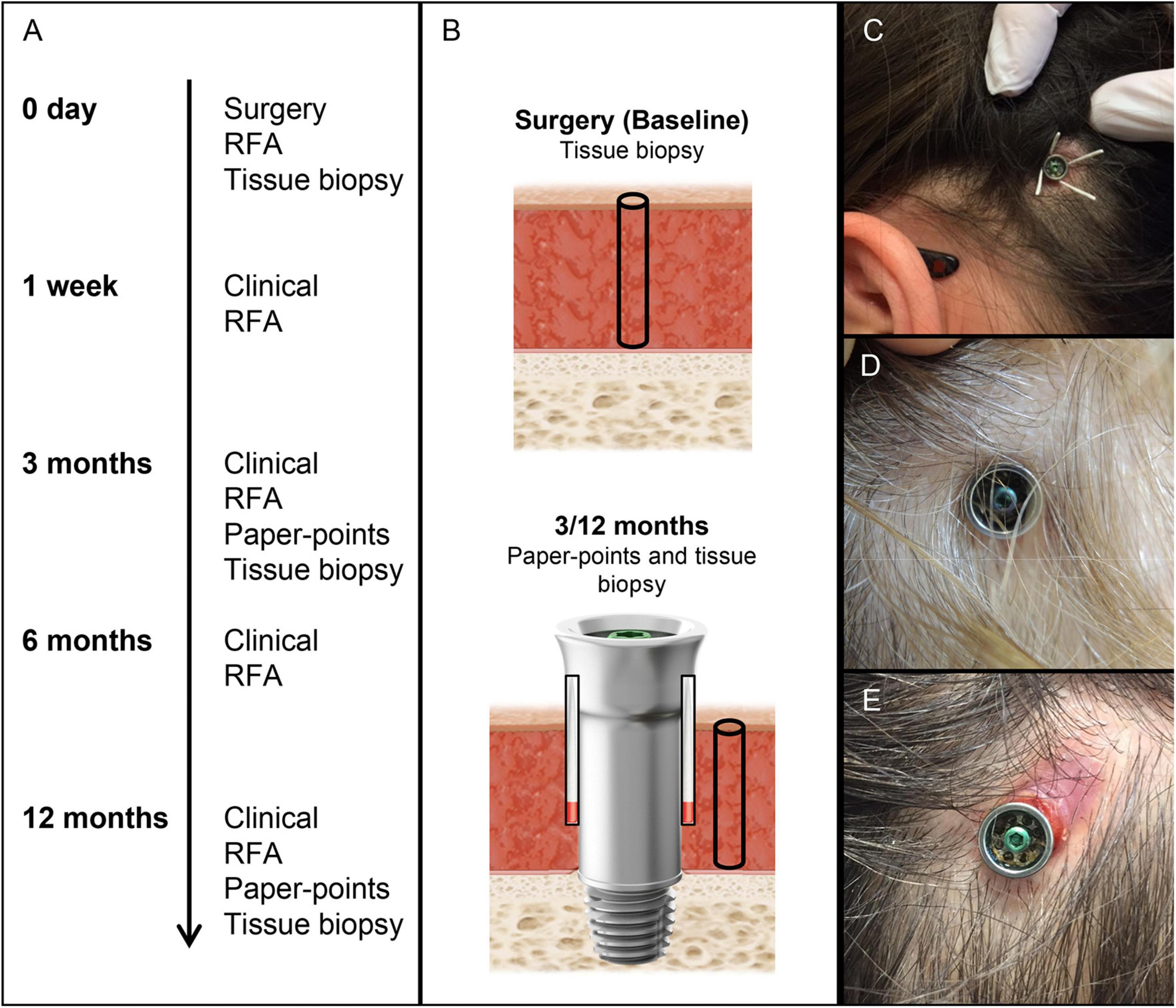 Frontiers  Non-invasive sampling procedure revealing the molecular events  at different abutments of bone-anchored hearing systems–A prospective  clinical pilot study