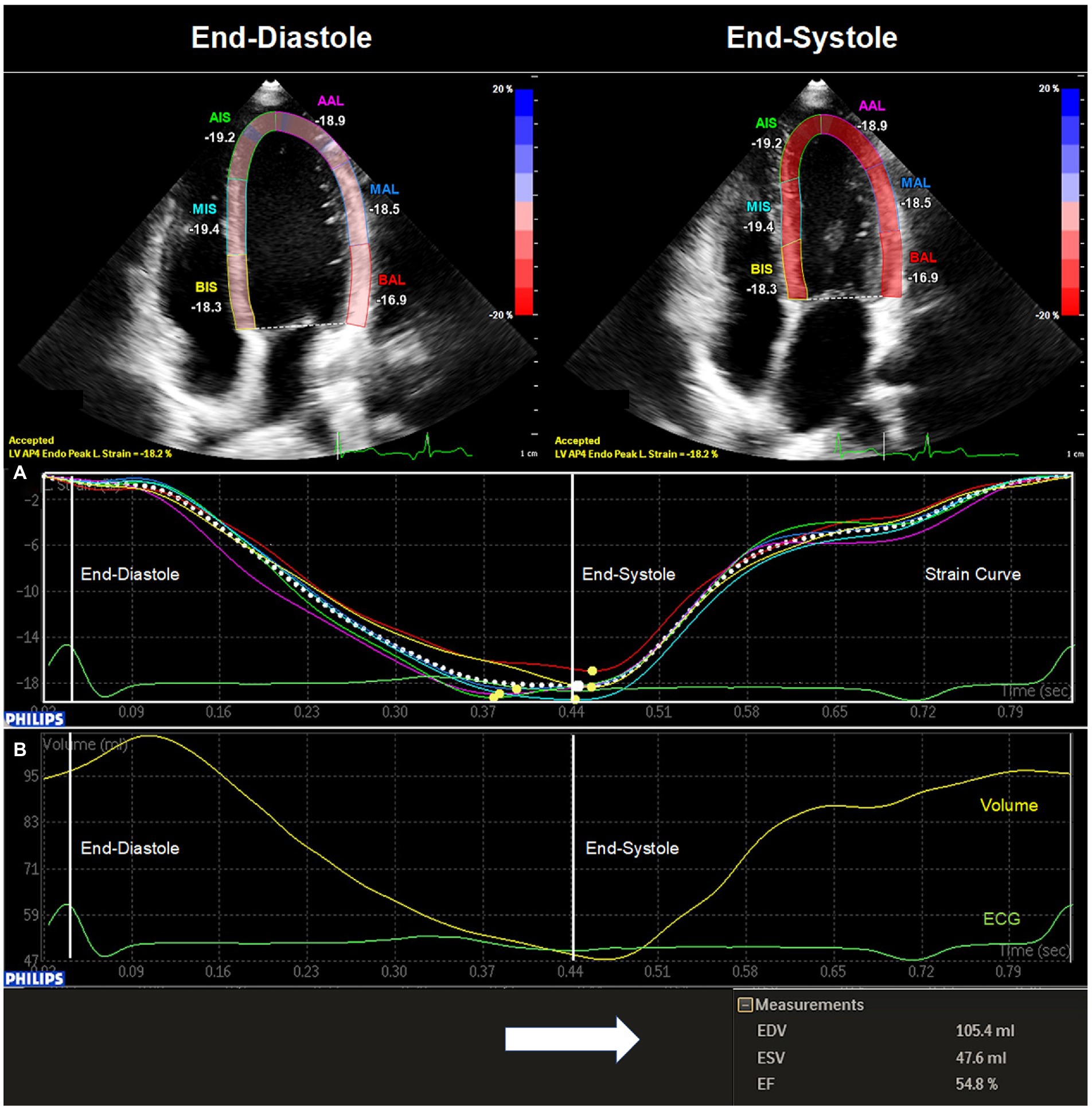 Speckle-tracking echocardiography. Semiautomatic calculation of global
