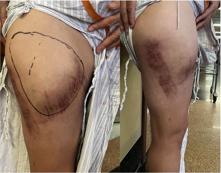Frontiers  The treatment of a Morel-Lavallée lesion of the thigh with  incision and drainage along with tissue debridement and a surgically placed  drain: A case report and literature review