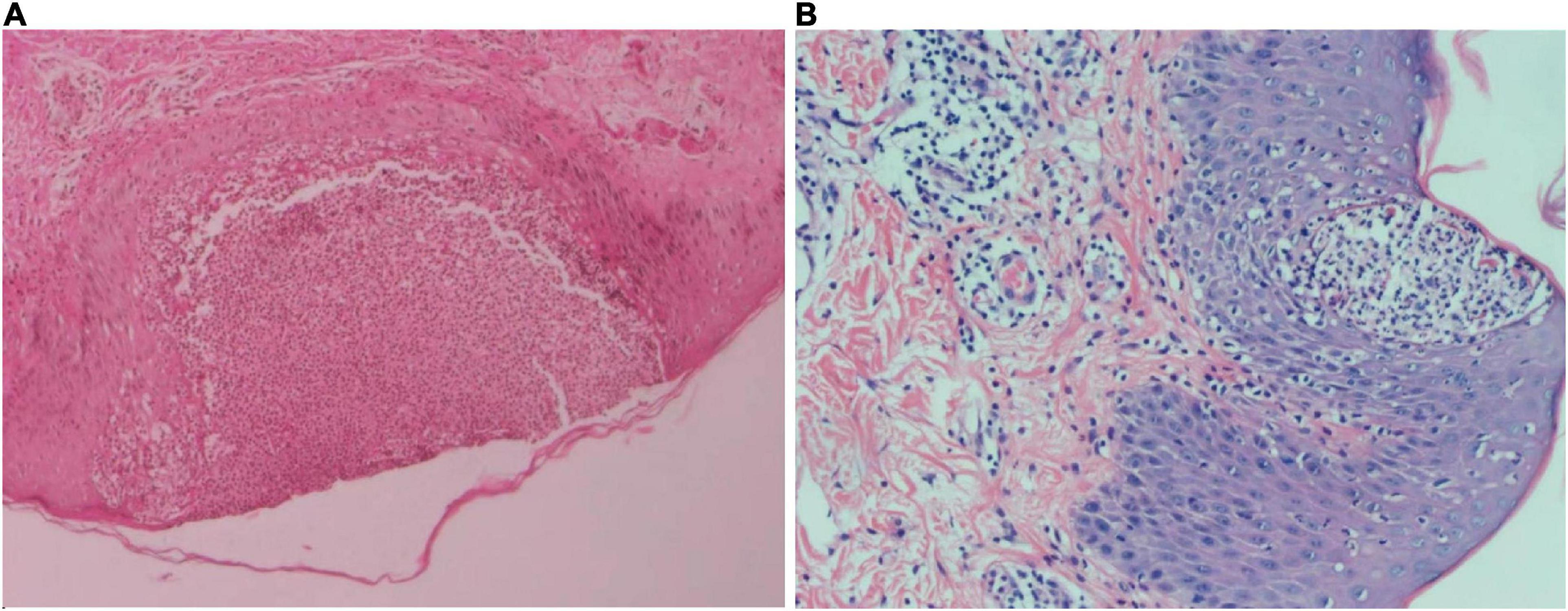 frontiers-case-report-successful-treatment-of-acute-generalized