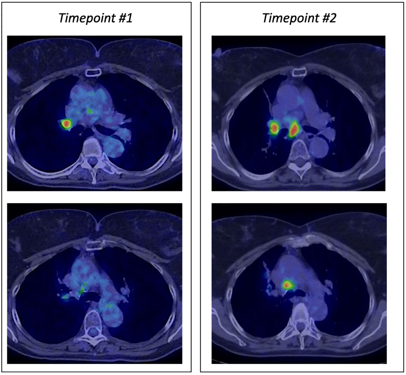 Frontiers | Case report: Successful use of mepolizumab for immune 