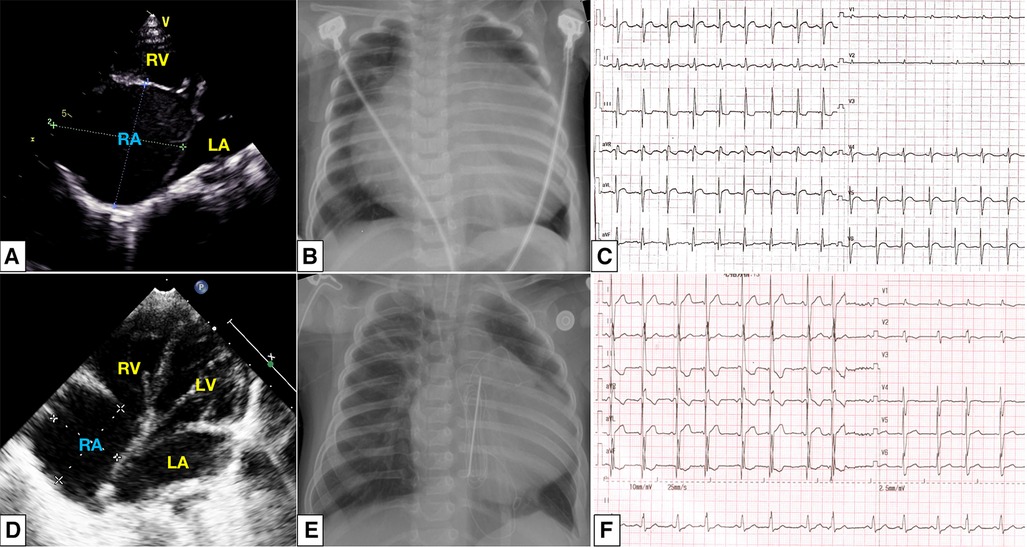 Giant Right Atrium In A Child With Dilated Cardiomyopathy A Case 