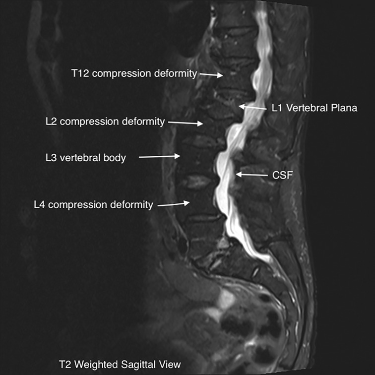 Acute and chronic vertebral compression fractures