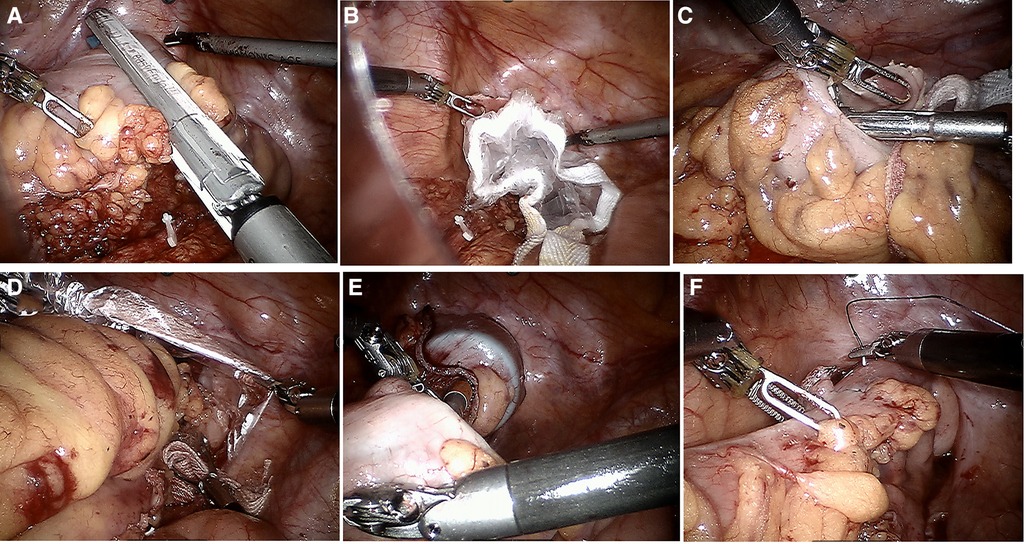 Observational images during laparoscopic surgery and gross specimens