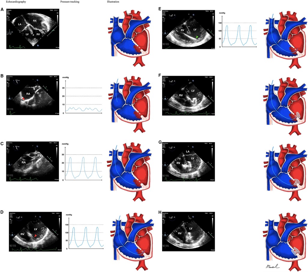 Frontiers | Transesophageal echocardiography-guided percutaneous 
