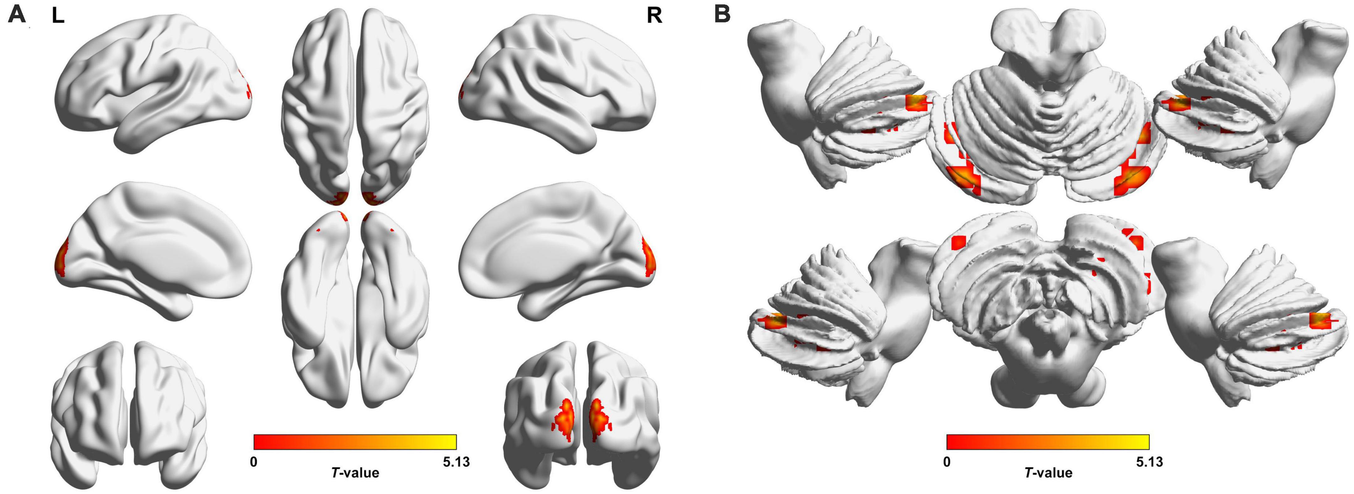 Frontiers  Morphometric and Functional Brain Connectivity