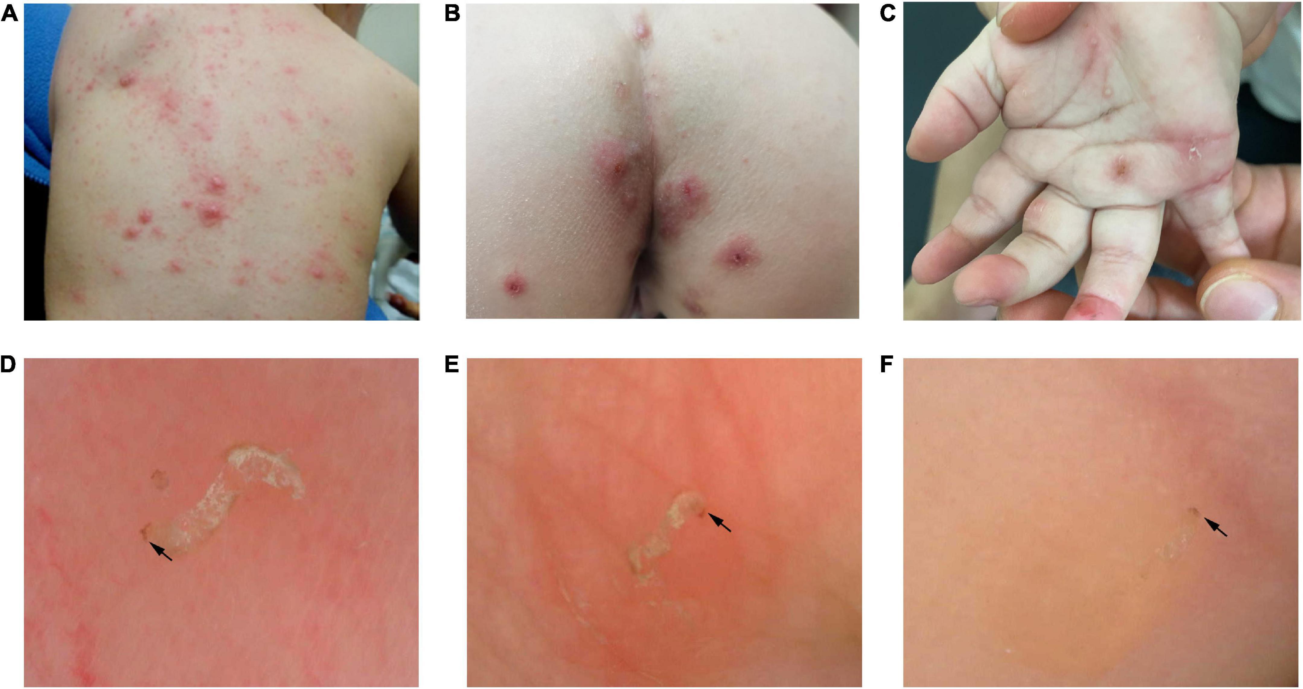 Frontiers Dermoscopic Features Of Children Scabies