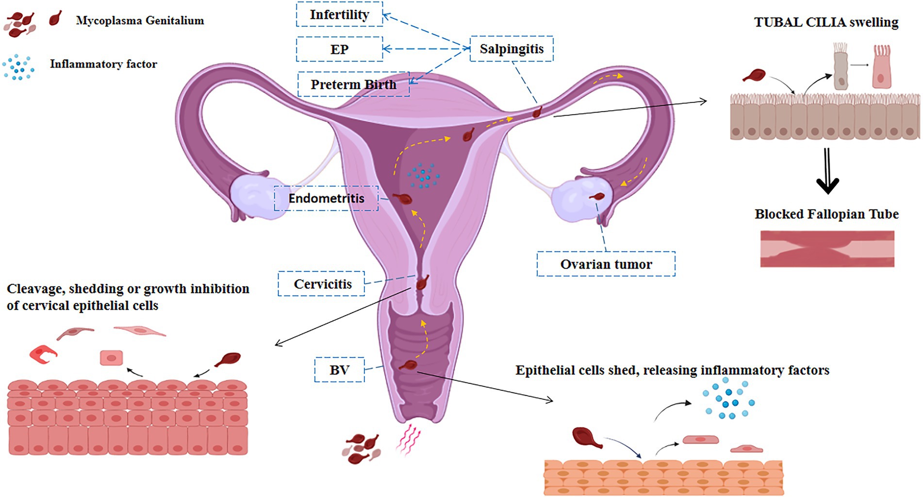 1902px x 1026px - Frontiers | Mycoplasma genitalium infection in the female reproductive  system: Diseases and treatment