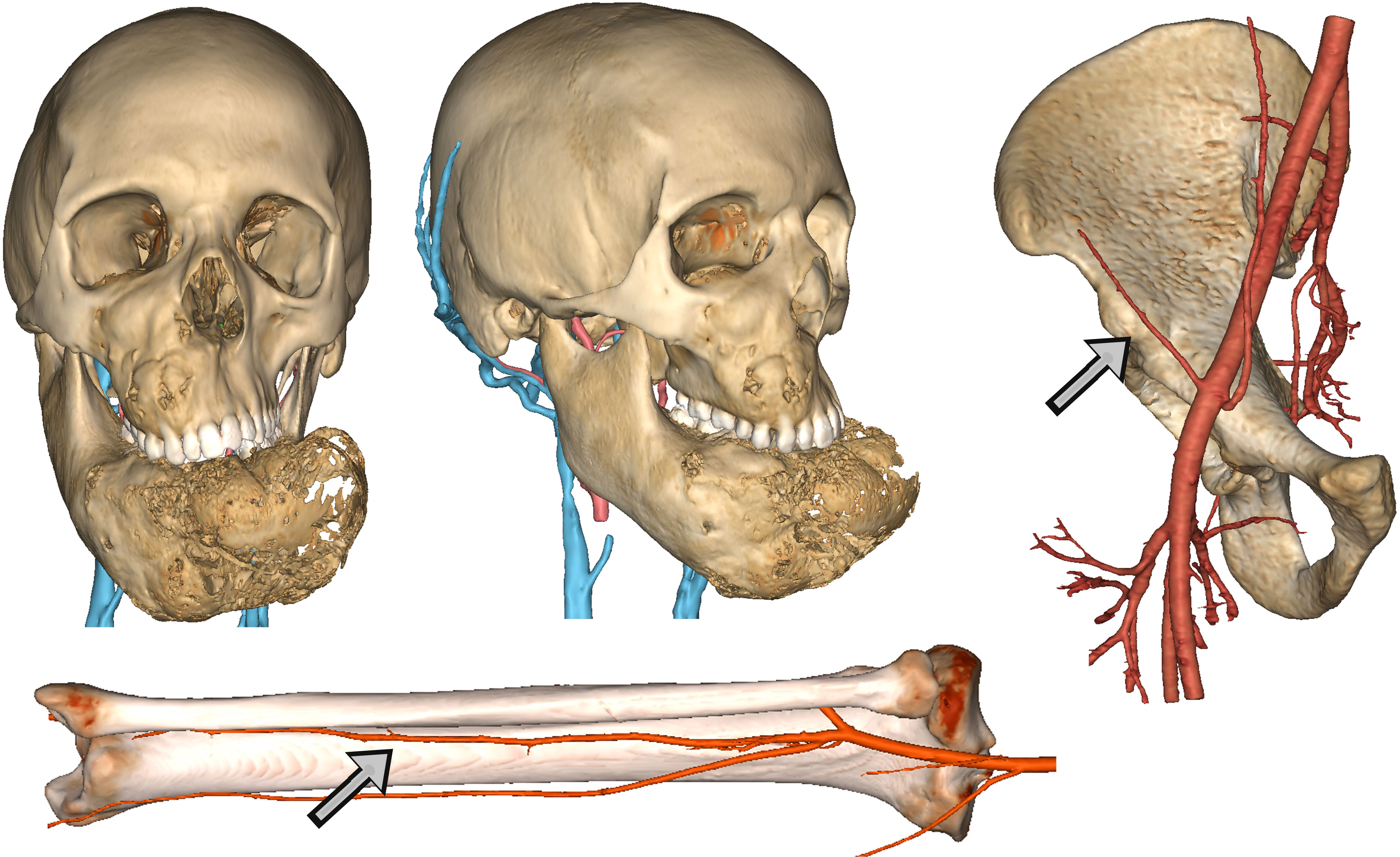 Frontiers  Double osseous flaps for simultaneous midfacial and mandible  reconstruction: Automation in surgical complexity within an entirely  computerized workflow