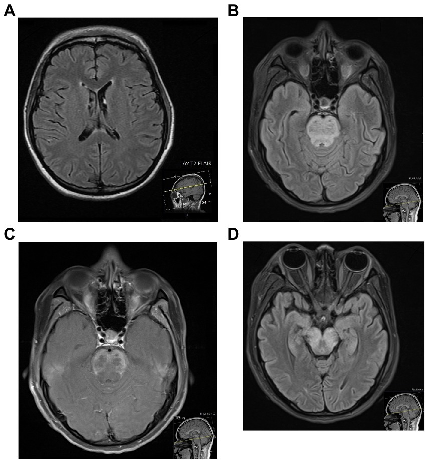 Frontiers | The Conundrum Of Neuropsychiatric Systemic Lupus ...