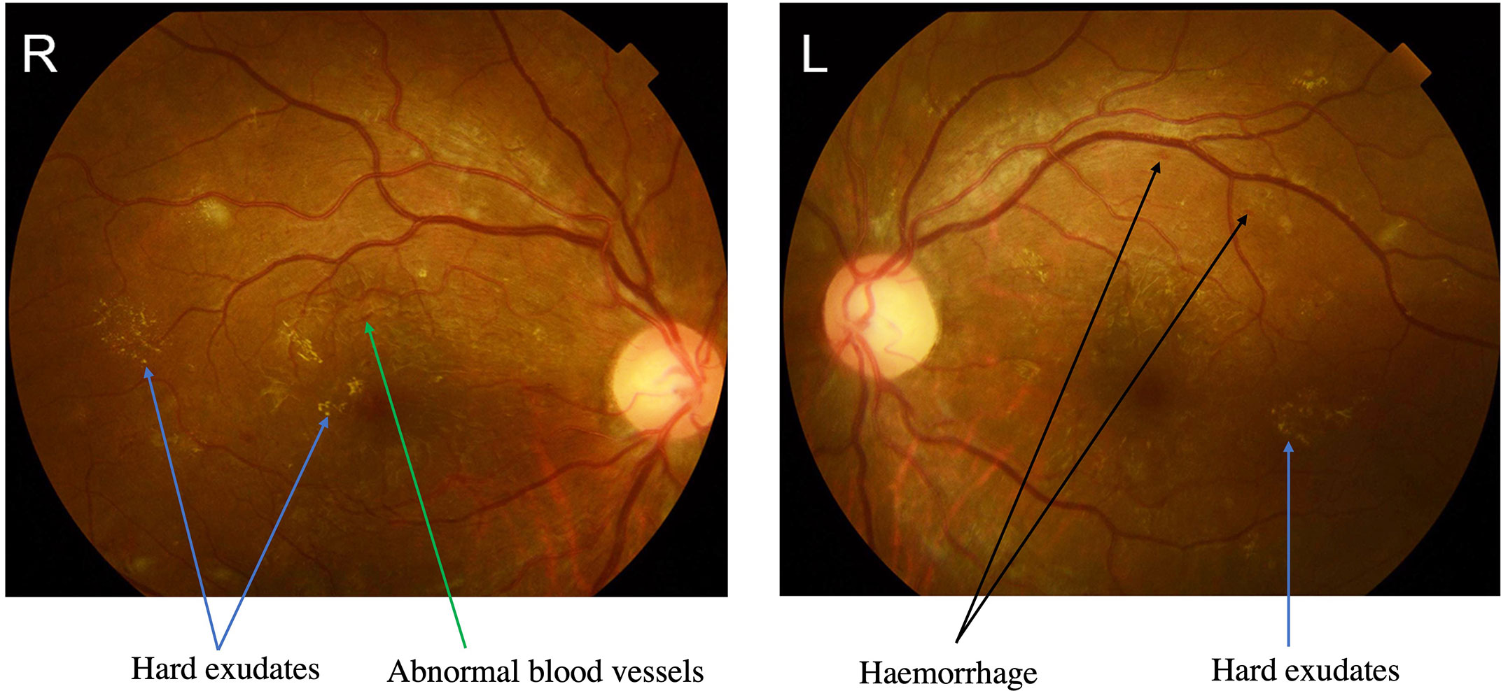 DKA and diabetic retinopathy