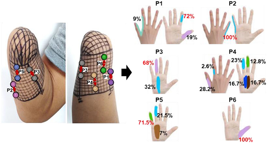 Targeted transcutaneous electrical nerve stimulation for phantom limb  sensory feedback