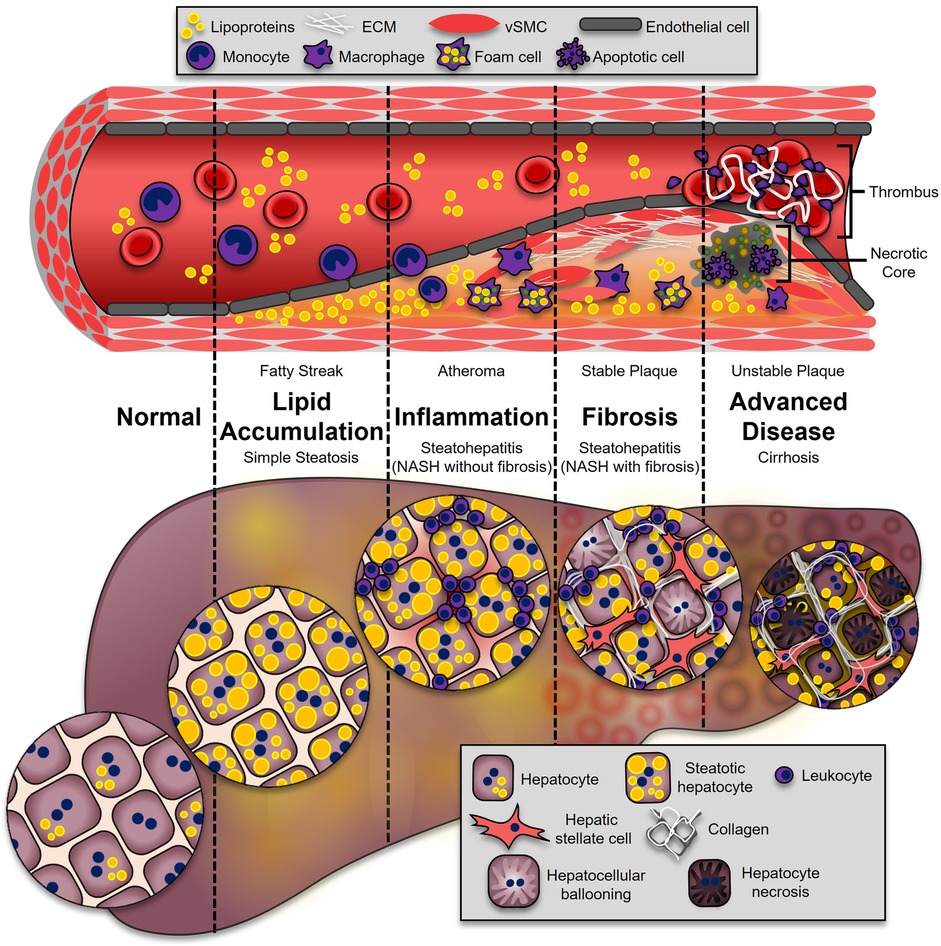 Frontiers | The interplay between nonalcoholic fatty liver disease