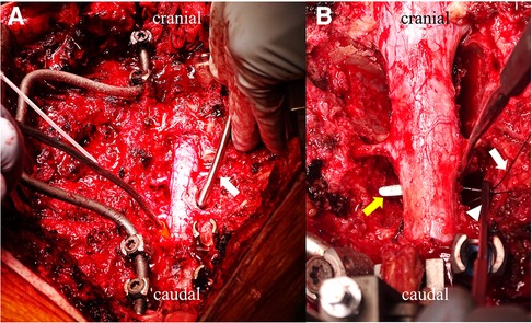 Frontiers | Anterior shift of the ventral dura mater: A novel 