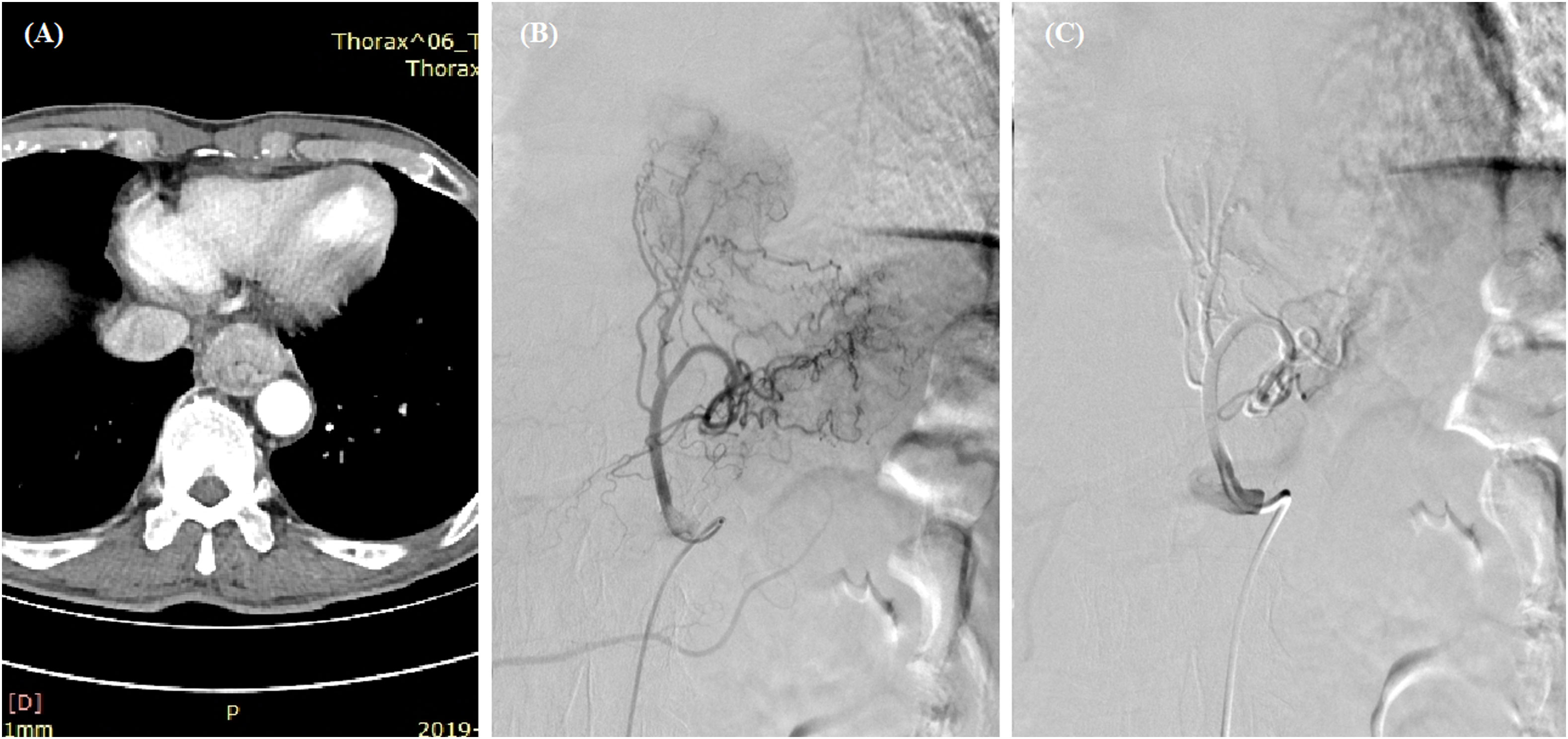 3158px x 1488px - Frontiers | Compression hemostasis using fully covered self-expandable  metallic stents for refractory hemorrhages caused by esophageal cancer: A  pilot study