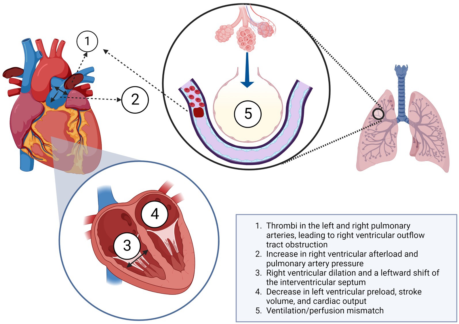 Frontiers | Hemodynamic and respiratory support in pulmonary embolism ...