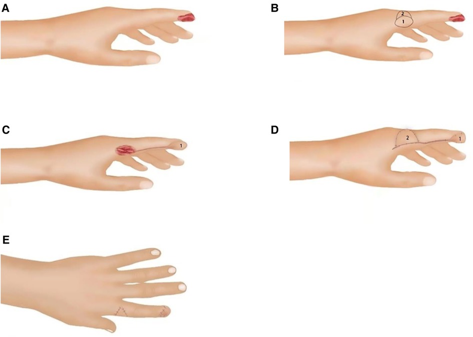 Frontiers Repair Of Fingertip Defect With Reverse Digital Artery 