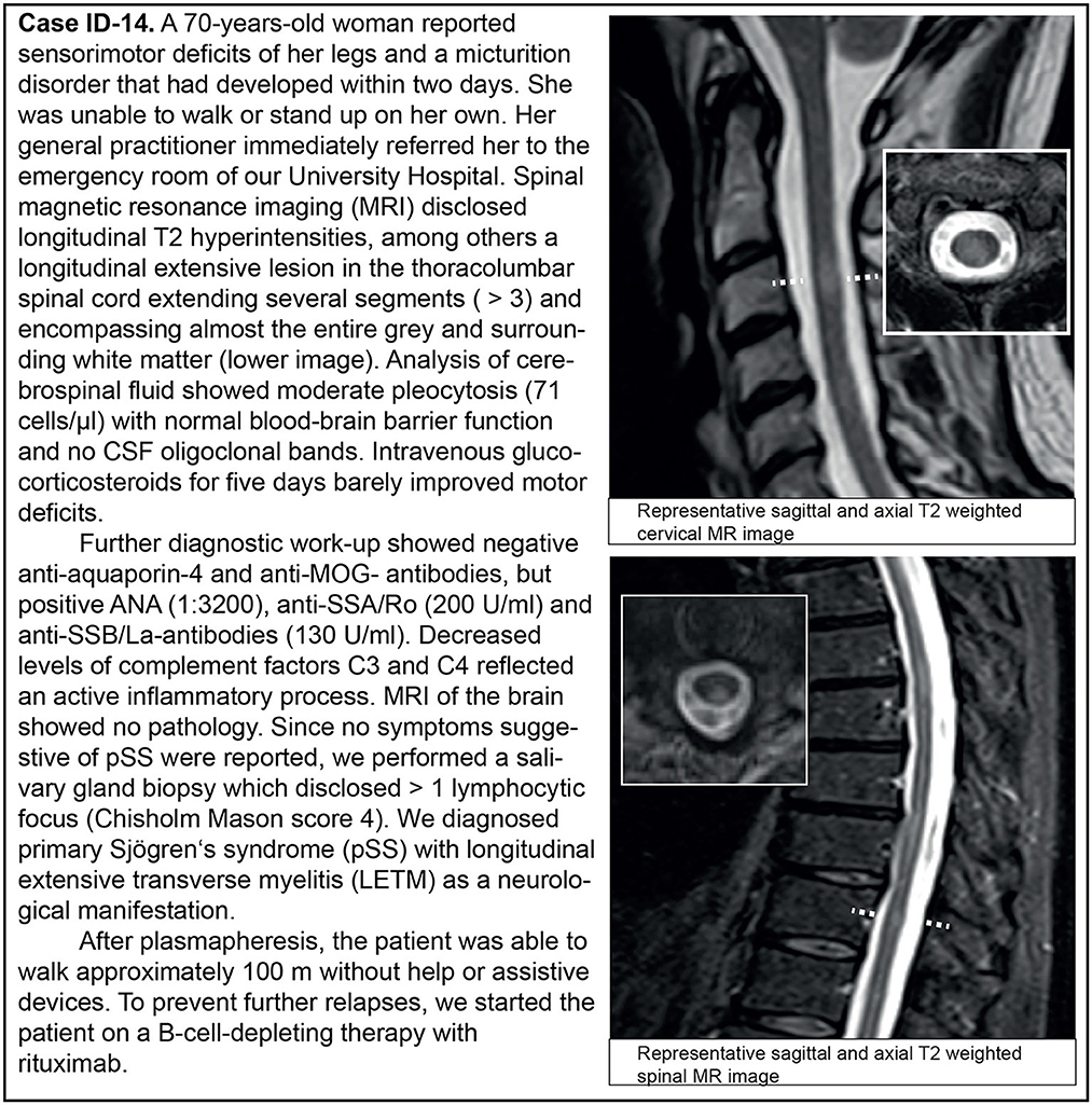 Frontiers | CNS Demyelinating Events In Primary Sjögren's Syndrome: A ...