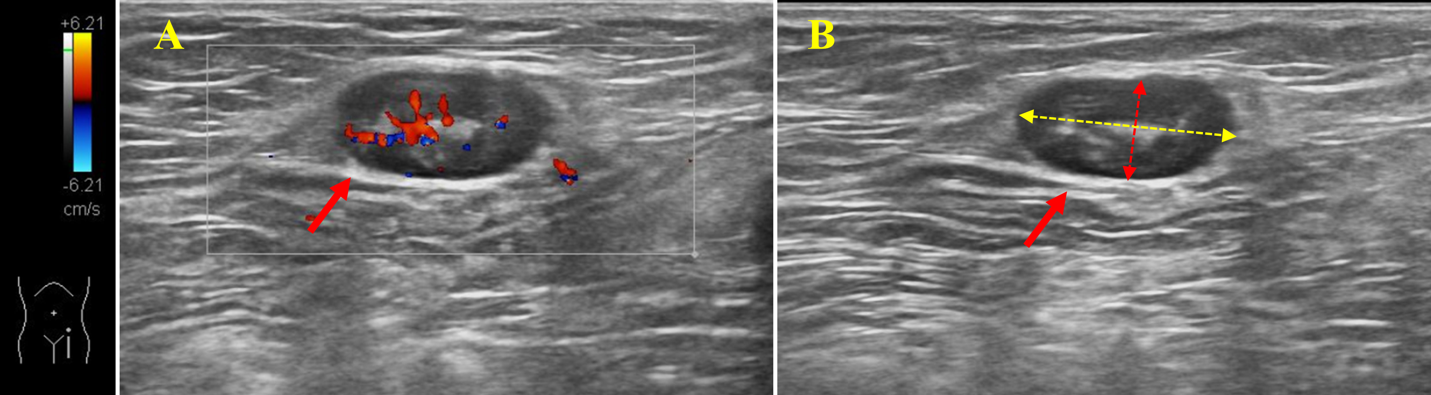 Swollen Inguinal Lymph Nodes