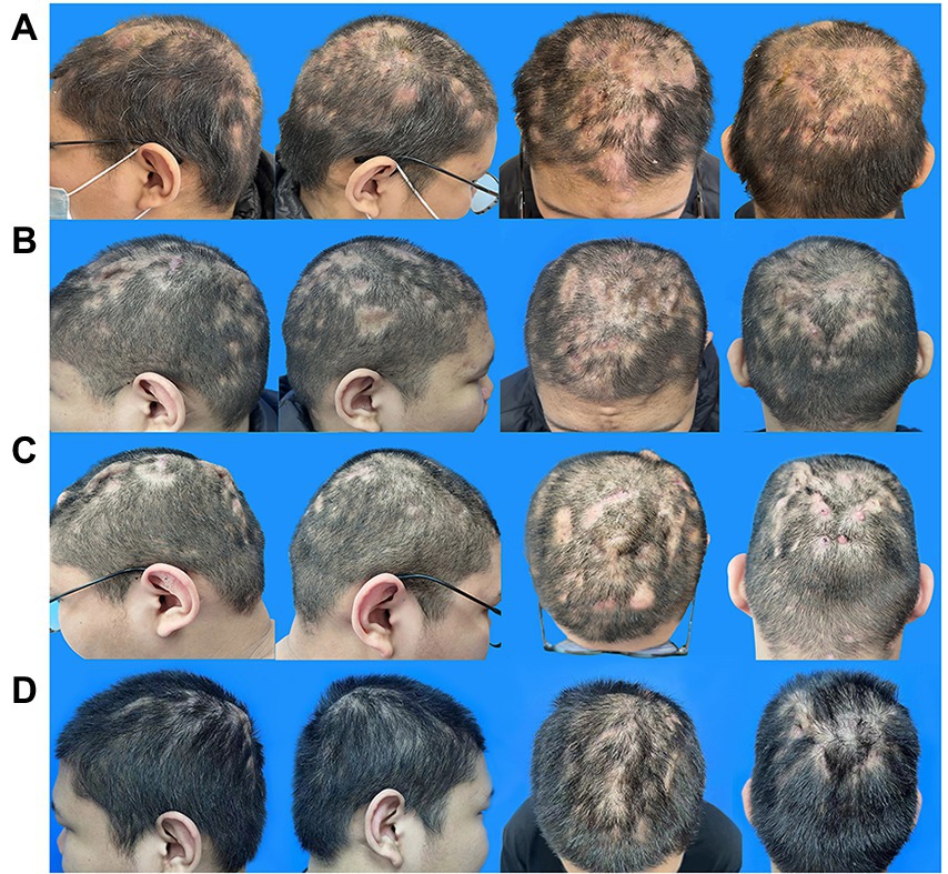 Figure 12 from Hypertrichosis the possible side effect of cyclosporin in  an infant with hemophagocytic lymphohistiocytosis receiving HLH2004  chemotherapy protocol  Semantic Scholar