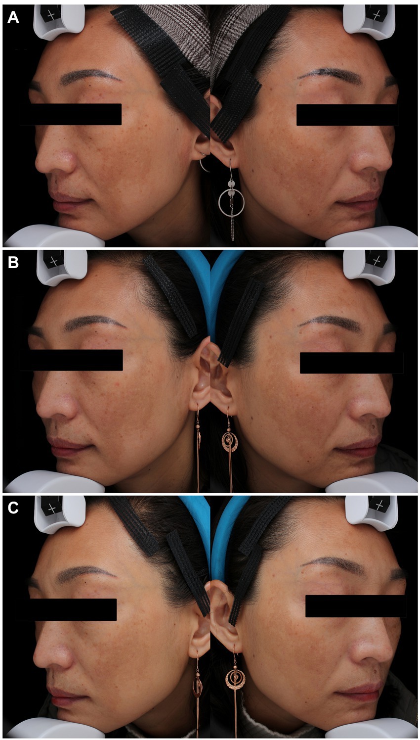 Frontiers Comparison Of The Efficacy And Safety Of Picosecond Ndyag Laser 1064 Nm