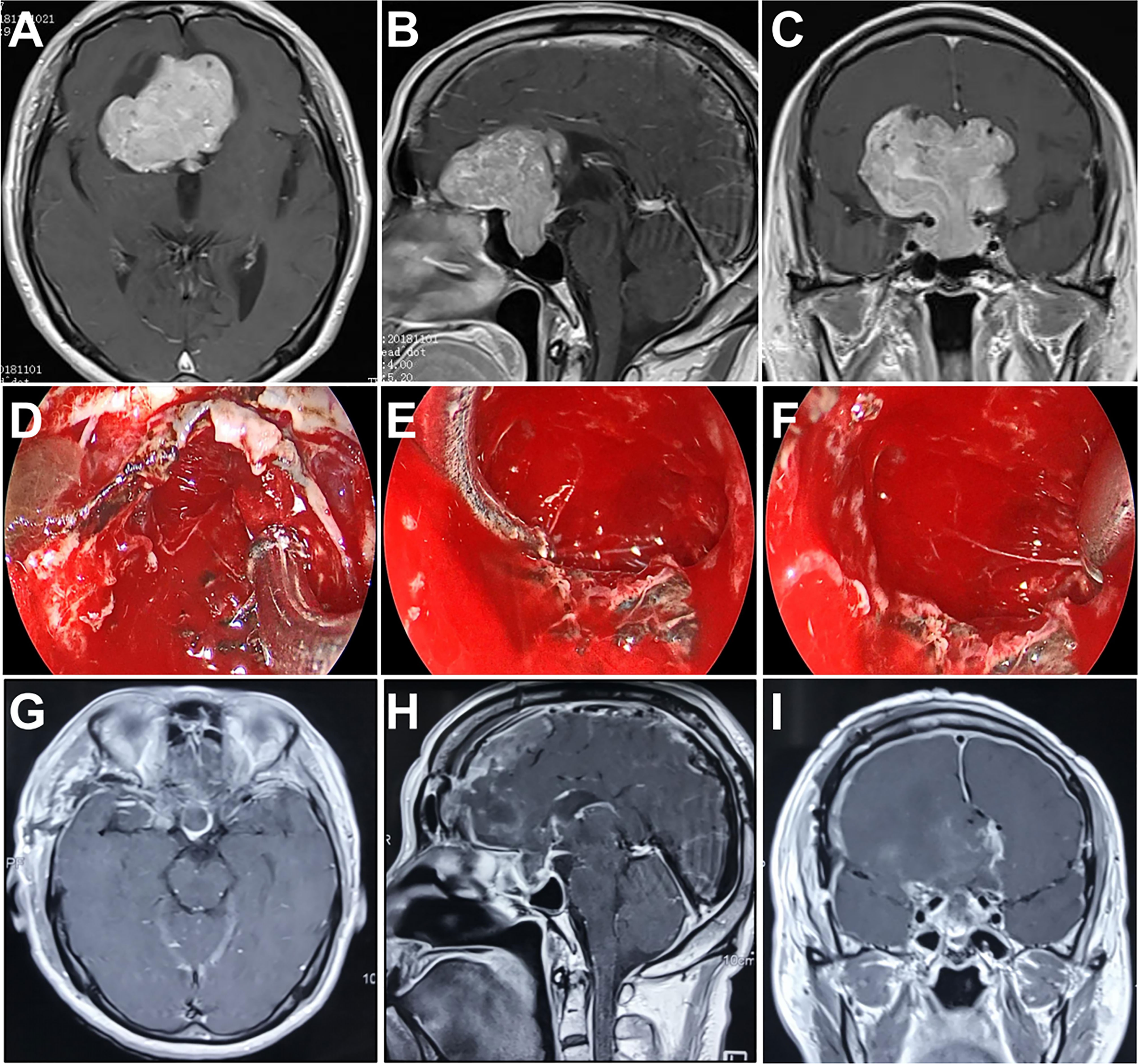 Frontiers  Outcome of giant pituitary tumors requiring surgery