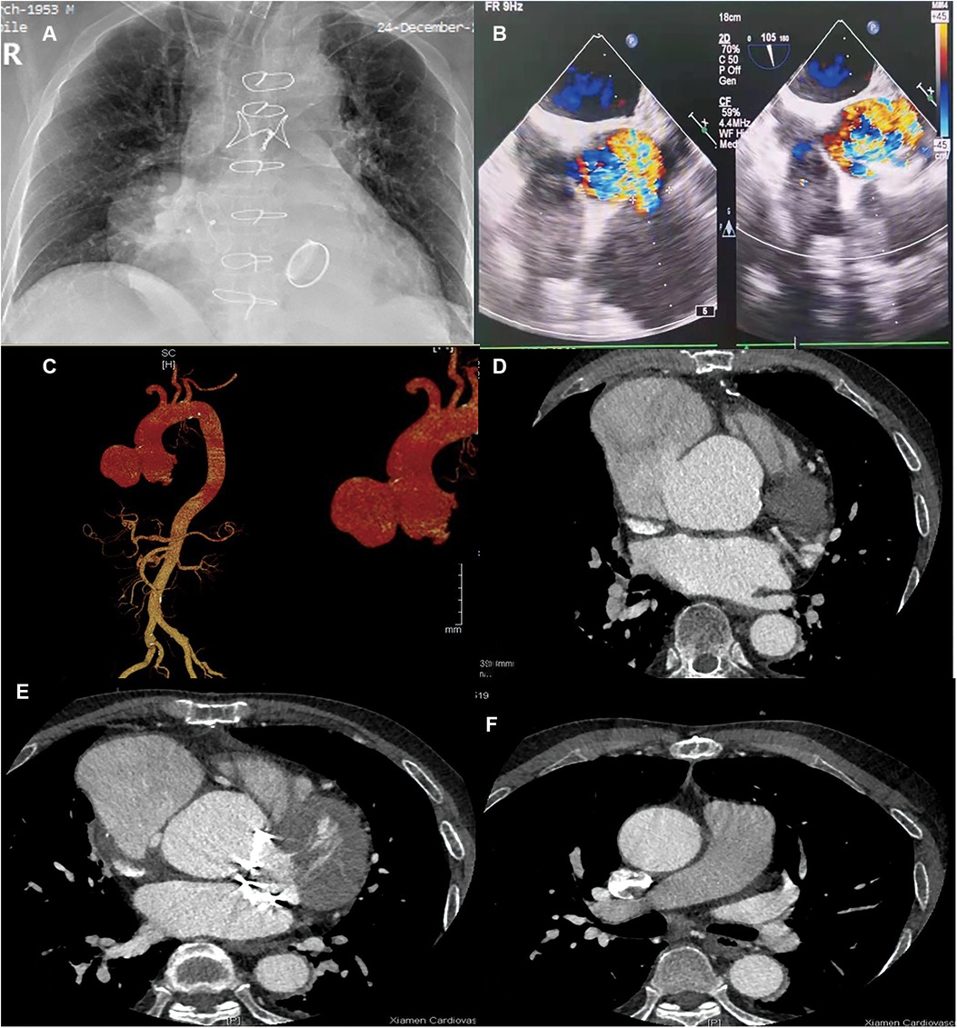 Frontiers | Minimally Invasive Closure Of A Progressive Pseudoaneurysm ...