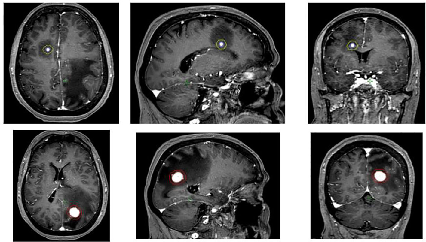 Frontiers | Impressive reduction of brain metastasis radionecrosis ...