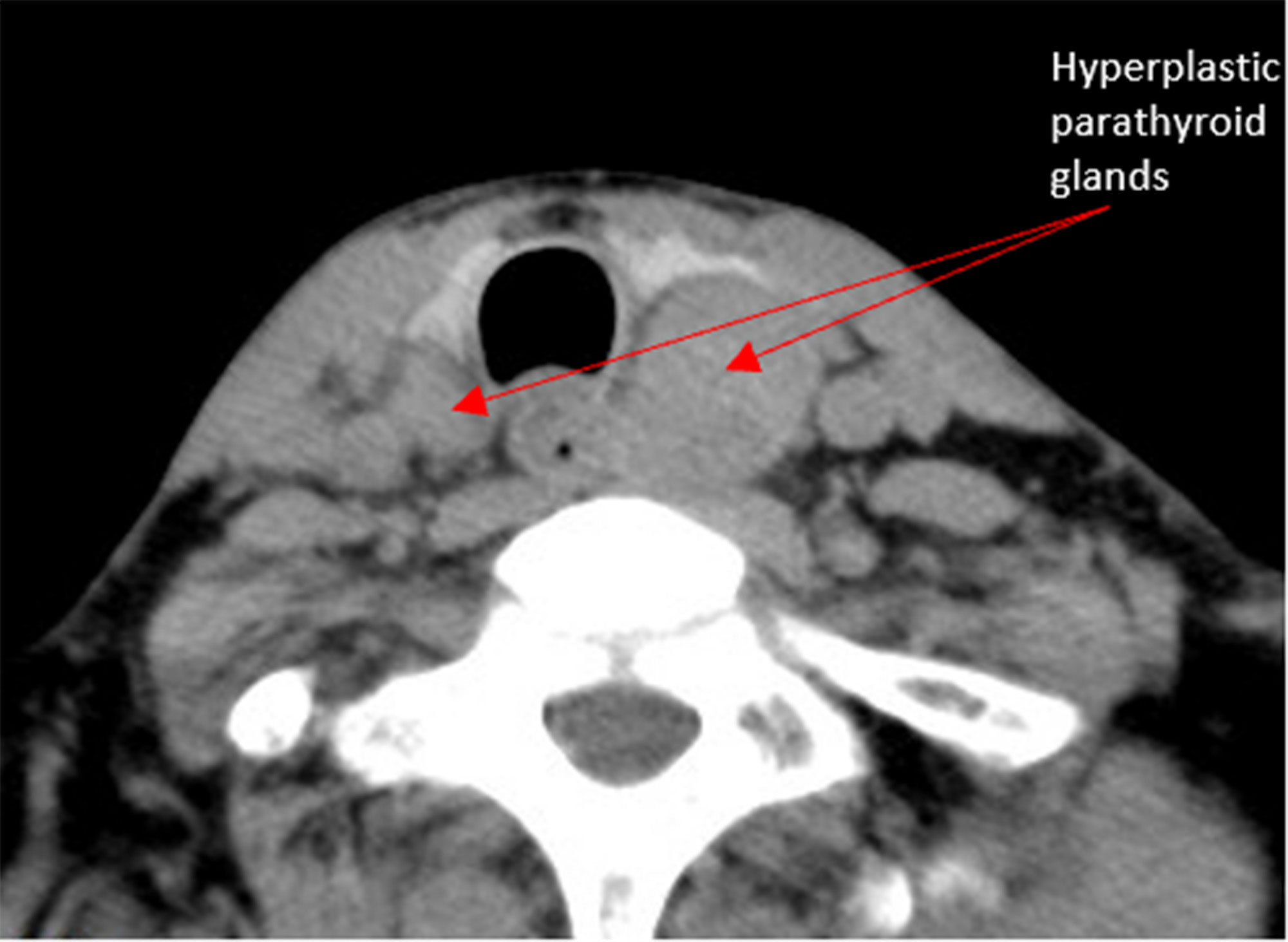 Frontiers Endoscopic total parathyroidectomy via anterior chest