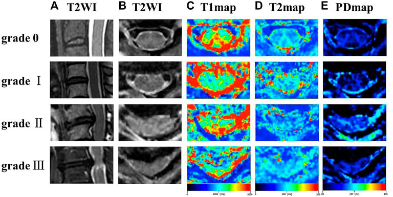 Assessment of degenerative cervical stenosis on T2-weighted MR imaging:  sensitivity to change and reliability of mid-sagittal and axial plane  metrics