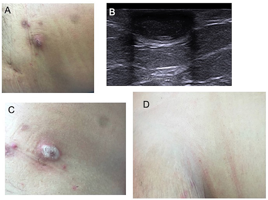Frontiers  Non-surgical treatment of hidradenitis suppurativa: the role of  cryotherapy