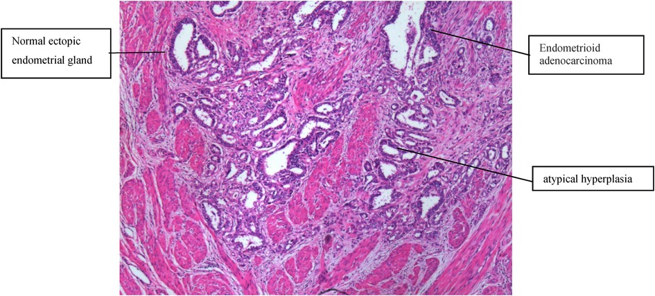Frontiers Endometrioid Adenocarcinoma Arising From Adenomyosis Two Case Reports And A 