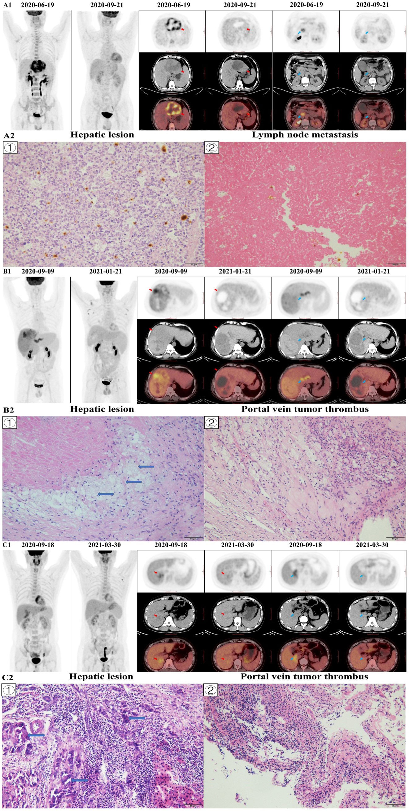 Frontiers | The Role Of 18F−FDG PET In Predicting The Pathological ...