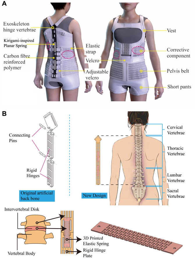 A Case Study of Initial In-Brace Spinal Correction of Anisotropic Textile  Brace and Boston Brace