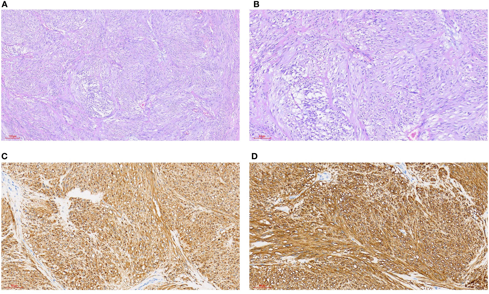 Frontiers  Nodular and diffuse spindle cell infiltration in