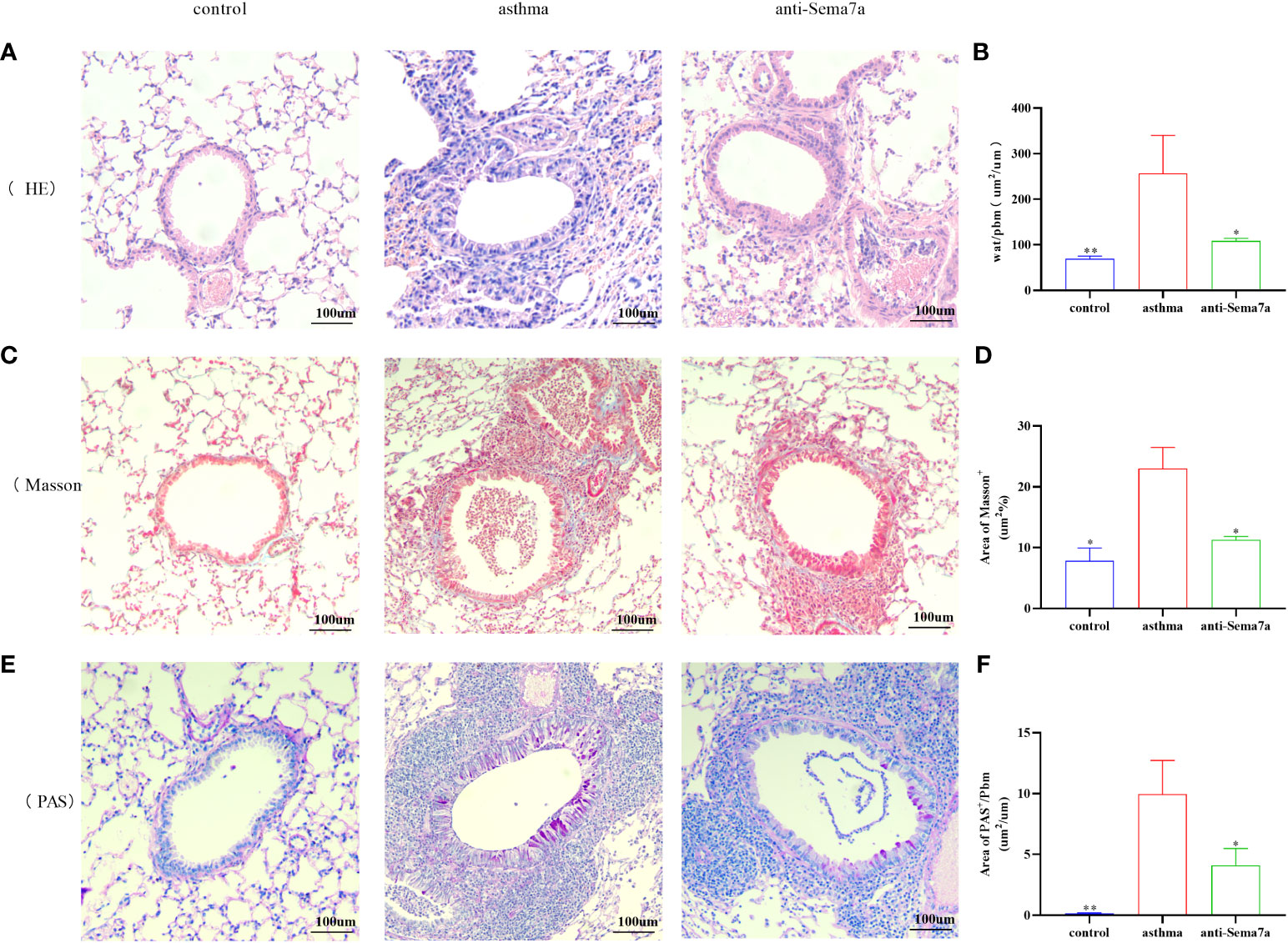 Frontiers | Semaphorin 7a aggravates TGF-β1-induced airway EMT 