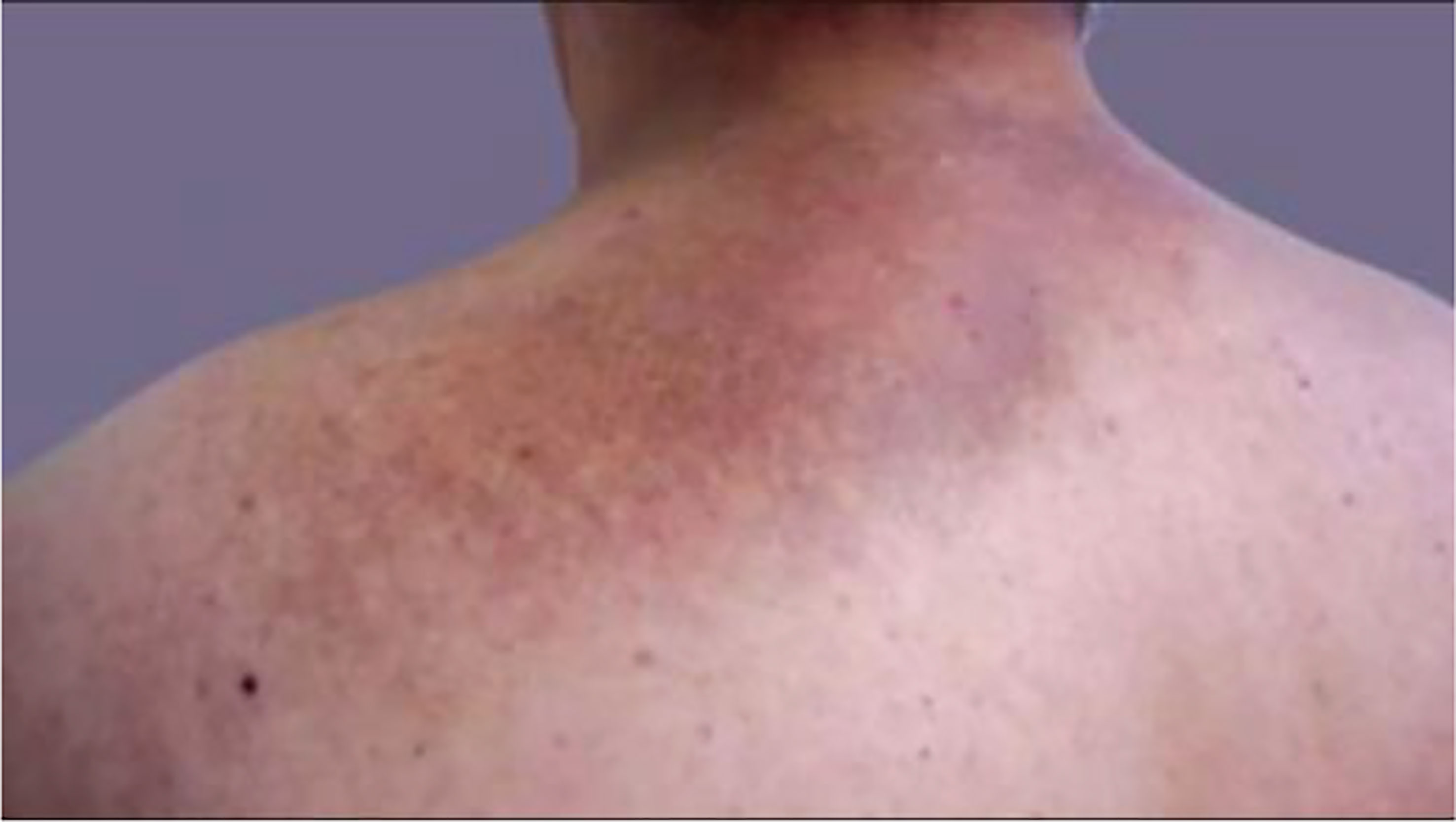 hypothyroidism skin rash