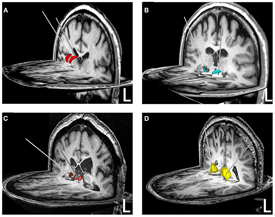 Frontiers | Deep Brain Stimulation For Patients With Refractory ...