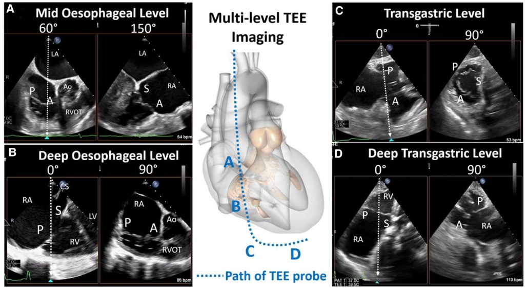 Frontiers  Multimodality imaging for transcatheter tricuspid valve repair  and replacement