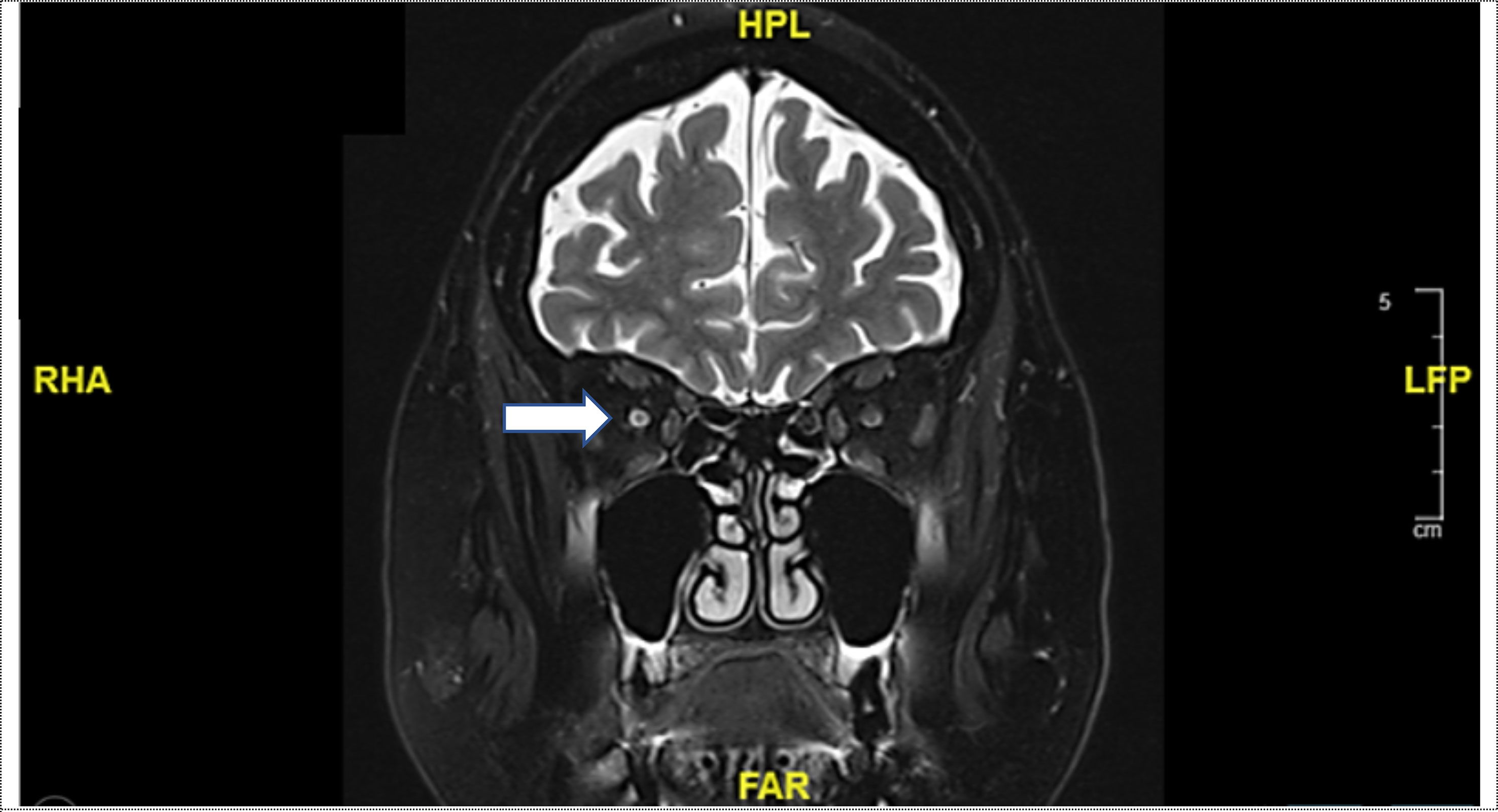 Frontiers | Pembrolizumab-induced Optic Neuropathy – A Case Report