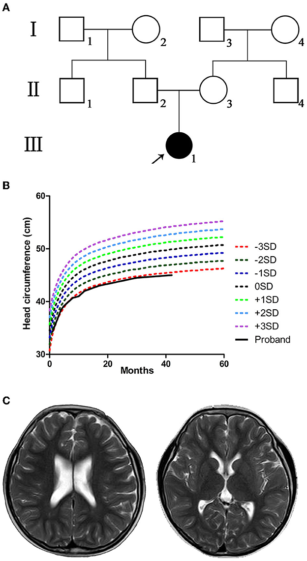 Cureus, Whole-Exome Sequencing Identified a Novel DYRK1A Variant in a  Patient With Intellectual Developmental Disorder, Autosomal Dominant 7