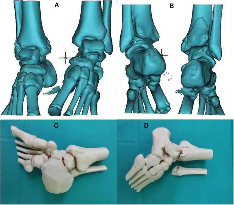 Frontiers  Clinical effects of 3D printing-assisted posterolateral  incision in the treatment of ankle fractures involving the posterior  malleolus