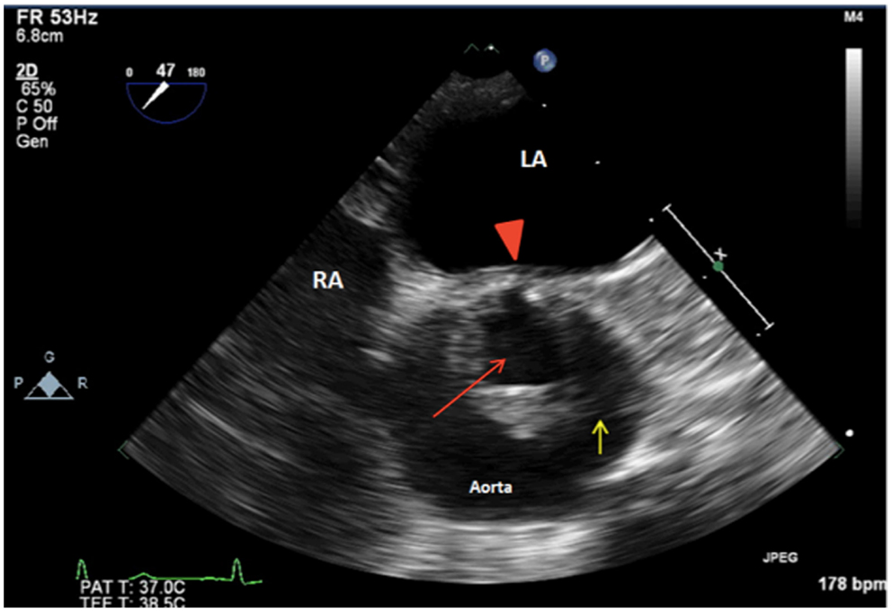 Frontiers Unicuspid Aortic Stenosis In A Patient With Turner Syndrome