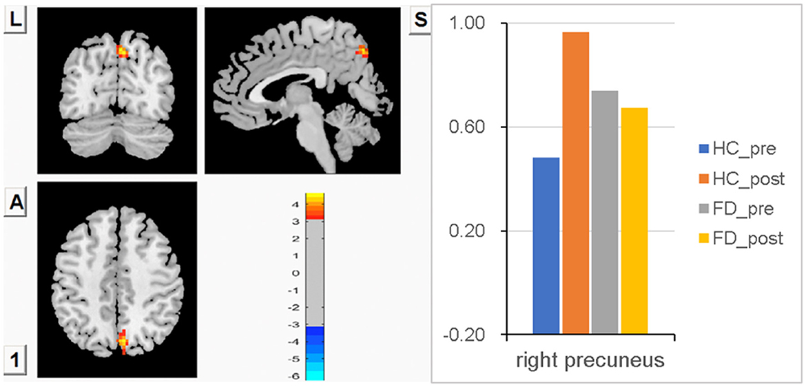 Frontiers  Differential responses from the left postcentral gyrus, right  middle frontal gyrus, and precuneus to meal ingestion in patients with  functional dyspepsia