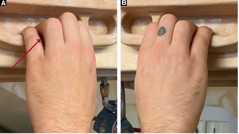 Frontiers | Clinical management of finger joint capsulitis/synovitis in ...